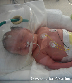 Bébé sous une cloche à oxygène suite à une détresse respiratoire © Association Césarine