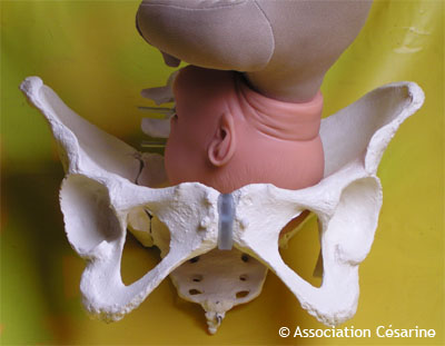 Bassin et Pelvimtrie - Figure 5 © Association Csarine